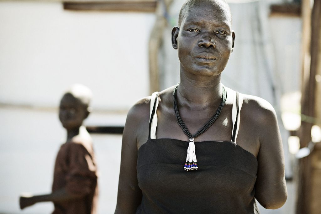 Kvinde i Sydsudan har mistet sin arm af skudsår